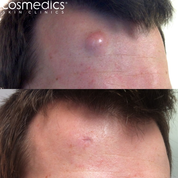 Cyst removal surgery